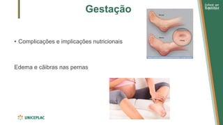 Gestação
• Complicações e implicações nutricionais
Edema e cãibras nas pernas
 