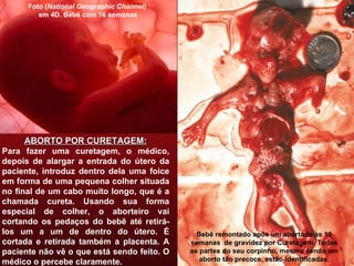 ABORTO POR CURETAGEM: Para fazer uma curetagem, o médico, depois de alargar a entrada do útero da paciente, introduz dentro dela uma foice em forma de uma pequena colher situada no final de um cabo muito longo, que é a chamada cureta. Usando sua forma especial de colher, o aborteiro vai cortando os pedaços do bebê até retirá-los um a um de dentro do útero. É cortada e retirada também a placenta. A paciente não vê o que está sendo feito. O médico o percebe claramente. Foto ( National Geographic Channel) em 4D. Bebê com 16 semanas Bebê remontado após um abortado às 10 semanas  de gravidez por Curetagem. Todas as partes do seu corpinho, mesmo sendo um aborto tão precoce, estão identificadas. 