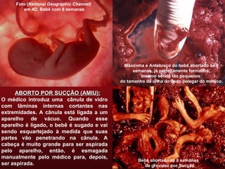 Foto ( National Geographic Channel) em 4D. Bebê com 8 semanas ABORTO POR SUCÇÃO (AMIU): O médico introduz uma  cânula de vidro com lâminas internas cortantes nas extremidades. A cânula está ligada a um aparelho de vácuo. Quando esse aparelho é ligado, o bebê é sugado e vai sendo esquartejado à medida que suas partes vão penetrando na cânula. A cabeça é muito grande para ser aspirada pelo aparelho, então, é esmagada manualmente pelo médico para, depois, ser aspirada. Bebê abortado às 8 semanas  de gravidez por Sucção Mãozinha e Antebraço do bebê abortado às 8 semanas, já perfeitamente formados, mesmo sendo tão pequenos:  do tamanho da unha do dedo polegar do médico. 