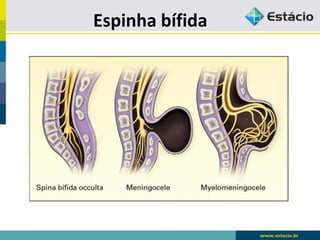 Espinha bífida
 