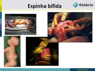 Espinha bífida
 