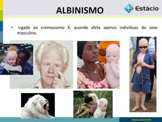 ALBINISMO
• Ligado ao cromossomo X, quando afeta apenas indivíduos do sexo
masculino.
 