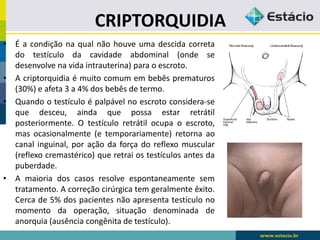 CRIPTORQUIDIA
• É a condição na qual não houve uma descida correta
do testículo da cavidade abdominal (onde se
desenvolve na vida intrauterina) para o escroto.
• A criptorquidia é muito comum em bebês prematuros
(30%) e afeta 3 a 4% dos bebês de termo.
• Quando o testículo é palpável no escroto considera-se
que desceu, ainda que possa estar retrátil
posteriormente. O testículo retrátil ocupa o escroto,
mas ocasionalmente (e temporariamente) retorna ao
canal inguinal, por ação da força do reflexo muscular
(reflexo cremastérico) que retrai os testículos antes da
puberdade.
• A maioria dos casos resolve espontaneamente sem
tratamento. A correção cirúrgica tem geralmente êxito.
Cerca de 5% dos pacientes não apresenta testículo no
momento da operação, situação denominada de
anorquia (ausência congênita de testículo).
 