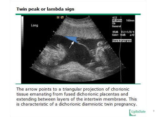Para entenderUSG(até 20 sem)2/3igualdiferentessexo“Unidas”separadasplacentadizigóticosMembrana IntergemelarouSinal do Lambdasimnãodicoriônicosmonocoriônicos7