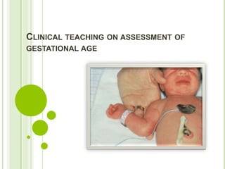 CLINICAL TEACHING ON ASSESSMENT OF
GESTATIONAL AGE
 