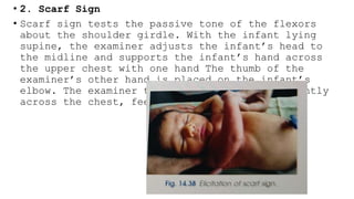 Carf Sign Gestational age estimation- pediatrics.pptx