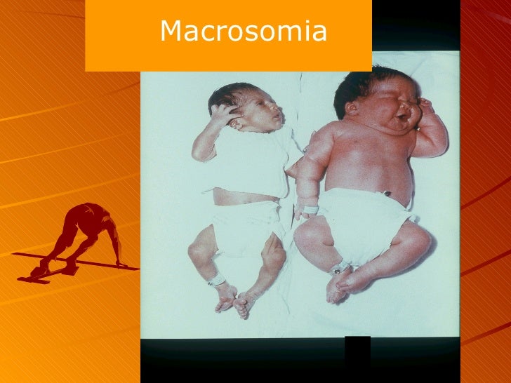 Diabetes Complications Baby Diabetes Complications Baby