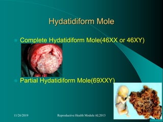 Hydatidiform Mole
 Complete Hydatidiform Mole(46XX or 46XY)
 Partial Hydatidiform Mole(69XXY)
11/26/2019 Reproductive Health Module AL2013
 