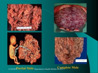 Partial Mole Complete Mole11/26/2019 Reproductive Health Module AL2013
 