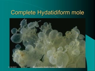 Complete Hydatidiform mole
11/26/2019 Reproductive Health Module AL2013
 
