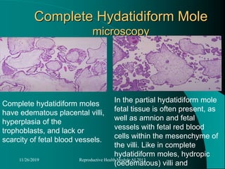 Complete Hydatidiform Mole
microscopy
Complete hydatidiform moles
have edematous placental villi,
hyperplasia of the
trophoblasts, and lack or
scarcity of fetal blood vessels.
11/26/2019 Reproductive Health Module AL2013
In the partial hydatidiform mole
fetal tissue is often present, as
well as amnion and fetal
vessels with fetal red blood
cells within the mesenchyme of
the villi. Like in complete
hydatidiform moles, hydropic
(oedematous) villi and
 