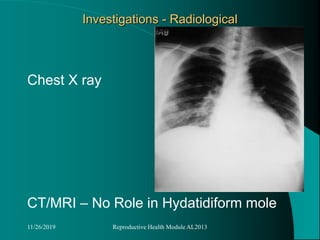 Investigations - Radiological
Chest X ray
CT/MRI – No Role in Hydatidiform mole
11/26/2019 Reproductive Health Module AL2013
 