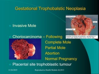 Gestational Trophobalstic Neoplasia
 Invasive Mole
 Choriocarcinoma – Following
Complete Mole
Partial Mole
Abortion
Normal Pregnancy
 Placental site trophoblastic tumour
11/26/2019 Reproductive Health Module AL2013
 