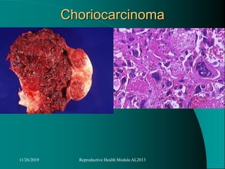 Choriocarcinoma
11/26/2019 Reproductive Health Module AL2013
 