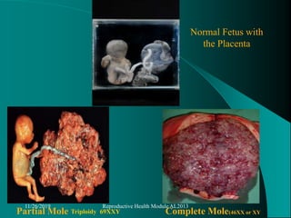 Partial Mole Complete Mole(46XX or XY
Normal Fetus with
the Placenta
Triploidy 69XXY
11/26/2019 Reproductive Health Module AL2013
 
