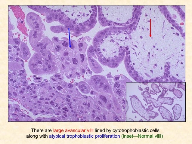 Gestational trophoblastic disease