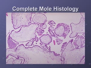 Complete Mole Histology
Complete Mole Histology
 