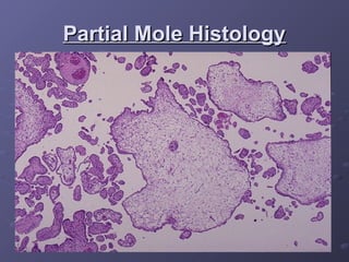 Partial Mole Histology
Partial Mole Histology
 
