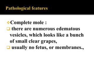 Complete mole :
 there are numerous   edematous
 vesicles, which looks like a bunch
 of small clear grapes,
 usually no fetus, or membranes.,
 