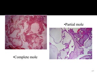•Partial mole




•Complete mole


                                 •17
 