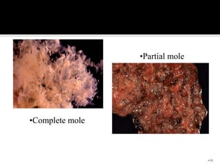 •Partial mole




•Complete mole



                                 •18
 