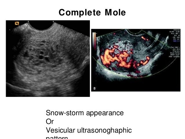 Gestational trophoblastic disease by sittichoke