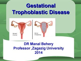 GestationalGestational
Trophoblastic DiseaseTrophoblastic Disease
 