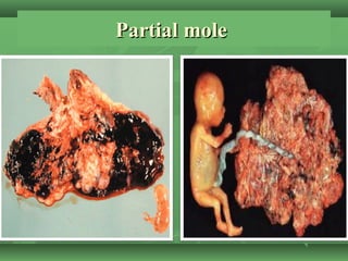 Partial molePartial mole
 