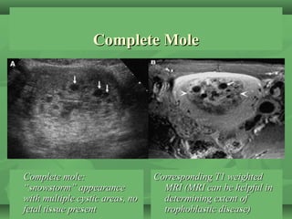Complete MoleComplete Mole
Complete mole:Complete mole:
“snowstorm” appearance“snowstorm” appearance
with multiple cystic ...