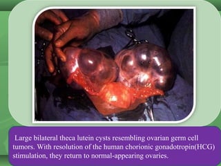 Large bilateral theca lutein cysts resembling ovarian germ cell tumors. With
resolution of the human chorionic gonadotropi...