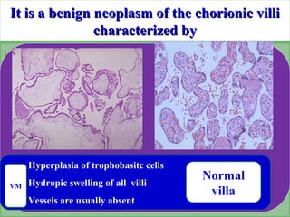 It is a benign neoplasm of the chorionic villiIt is a benign neoplasm of the chorionic villi
characterized bycharacterized...