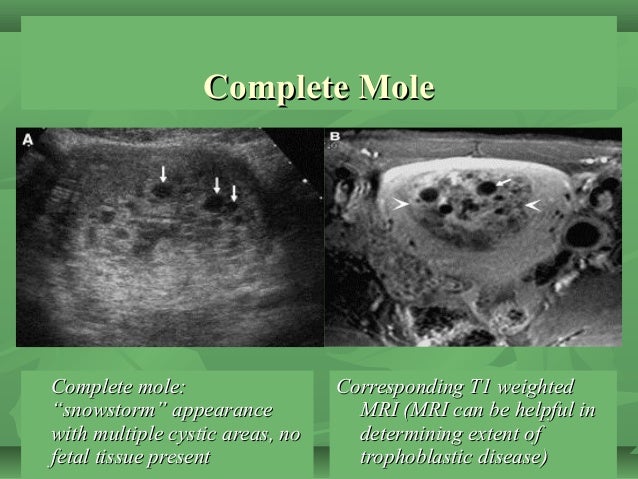 Gestational trophoblastic disease for undergraduate