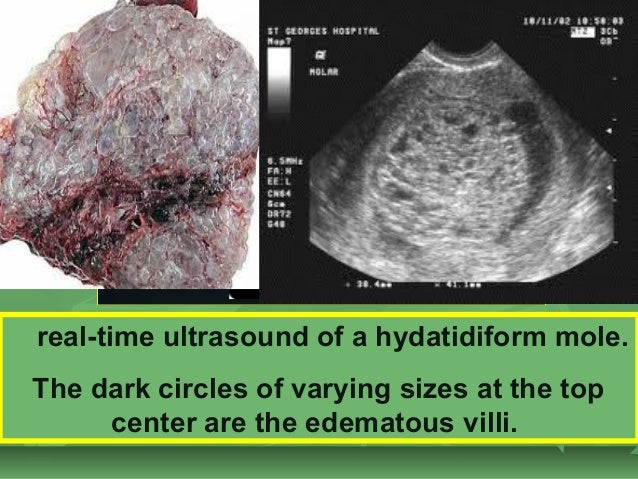 gestational trophoblastic disease