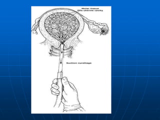 Gestational trophoblastic disease (gtd.version gao) | PPTX