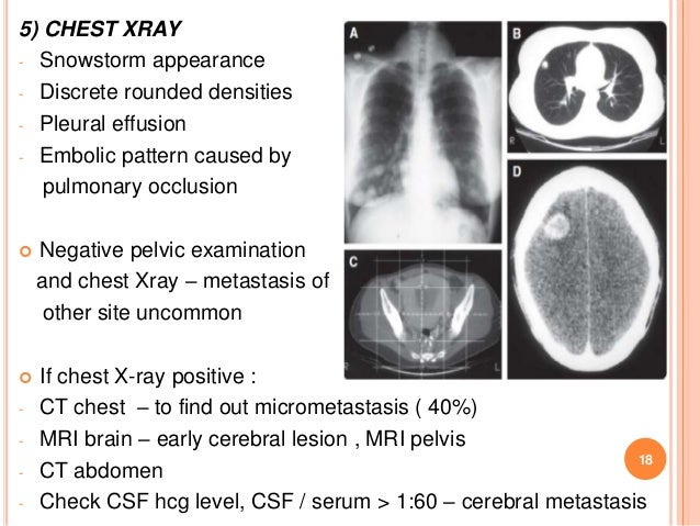 Gestational trophoblastic disease part 21 copy