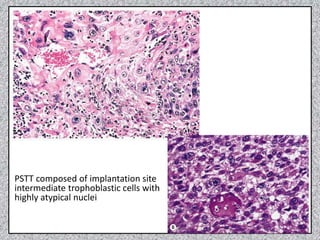 Pstt GESTATIONAL TROPHOBLASTIC DISEASES.pptx