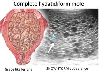 Complete hydatidiform mole
Grape like lesions SNOW STORM appearance
 
