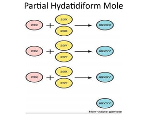 Partial Hydatidiform Mole
 
