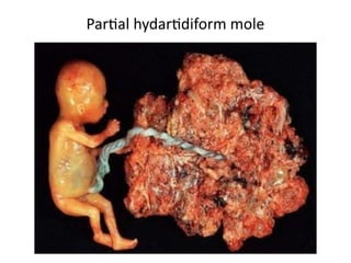 Partial hydartidiform mole
 