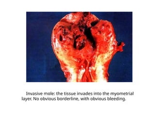 Invasive mole: the tissue invades into the myometrial
layer. No obvious borderline, with obvious bleeding.
 