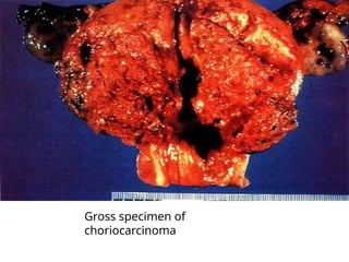 Gross specimen of
choriocarcinoma
 