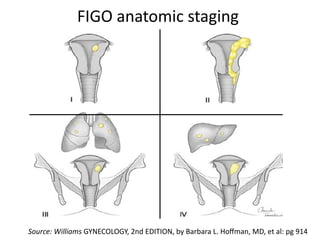 FIGO anatomic staging
Source: Williams GYNECOLOGY, 2nd EDITION, by Barbara L. Hoffman, MD, et al: pg 914
 