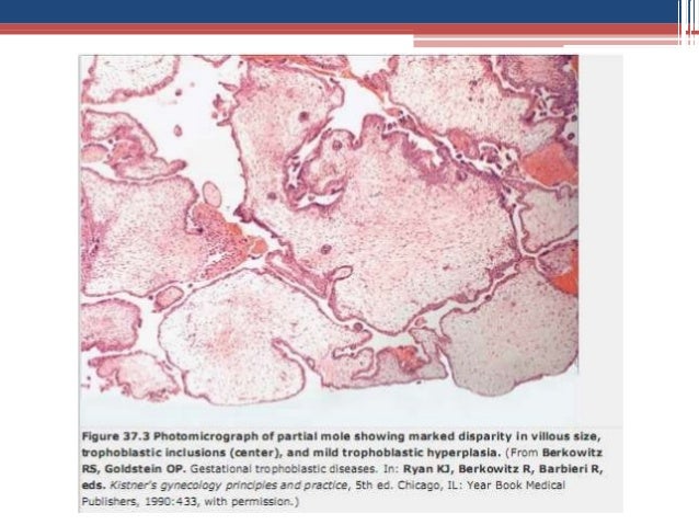 Gestational trophoblastic neoplasia management