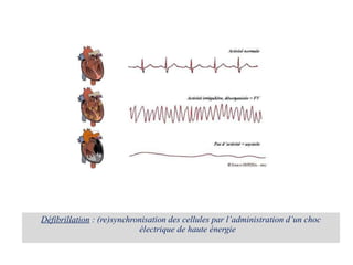 Défibrillation  : (re)synchronisation des cellules par l’administration d’un choc électrique de haute énergie 