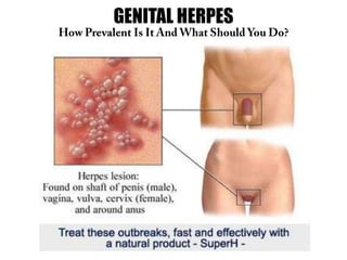 GENITAL HERPES
How Prevalent Is It And What Should You Do?
 