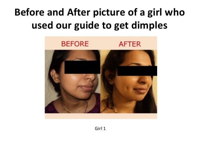 get dimples naturally without surgery how do dimples form