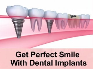 Get Perfect Smile 
With Dental Implants 
 