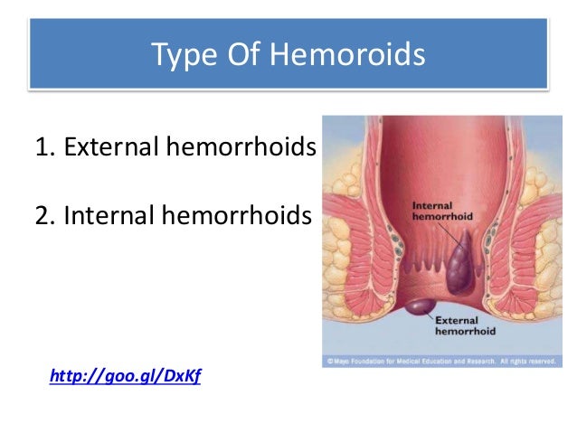 Get rid of hemorrhoids Fast