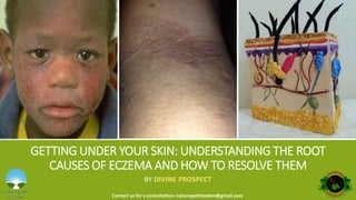 GETTING UNDER YOUR SKIN: UNDERSTANDING THE ROOT
CAUSES OF ECZEMA AND HOW TO RESOLVE THEM
BY DIVINE PROSPECT
Contact us for a consultation: naturopathtoeden@gmail.com
 