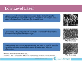 Low Level Laser
LipoLaser (Low level lasers) containing laser diodes that emit specific
wavelengths of light designed to target fat cells (635 to 650 nm) are placed
on the patient’s skin for 10 minutes per treatment area.
Low level laser technology has been studied and used for over 30 years for
many biomedical purposes including wound healing, pain relief and
inflammation.
After 4 minutes
After 6 minutes
Laser energy safely and painlessly penetrates several millimeters into the
subcutaneous adipose or fat tissue layer.
*Reference : Plastic Andreconstructive Surgery,
September 1, 2002 – Fat liquefaction : Effect of low level laser energy on Adipose Tissue by Neira et al.
www.getwelluae.com
 